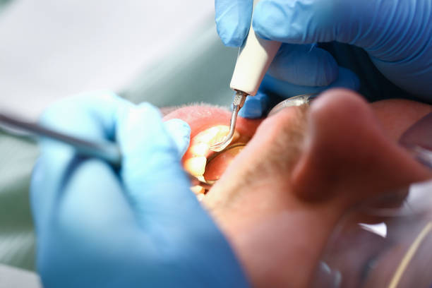 Best Urgent Care for Lost Fillings or Crowns in West Hamburg, PA